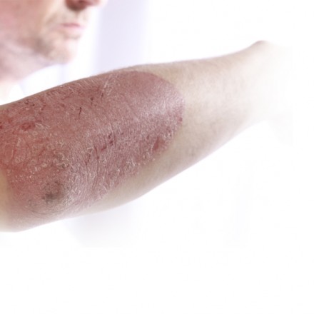 Plaque Psoriasis (CAIN457A2322) Plaque Psoriasis (CAIN457A2322)