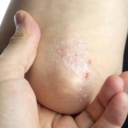 Plaque Psoriasis (20101177) Plaque Psoriasis (20101177)