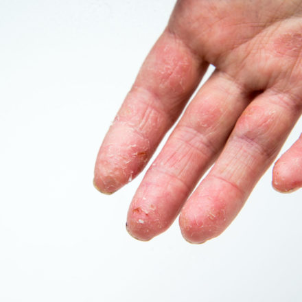 Eczema in Adults & Adolescents (M16-813) Eczema in Adults & Adolescents (M16-813)